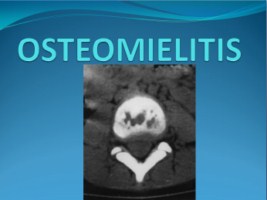 osteomielitis graviola osteomielitis graviola
